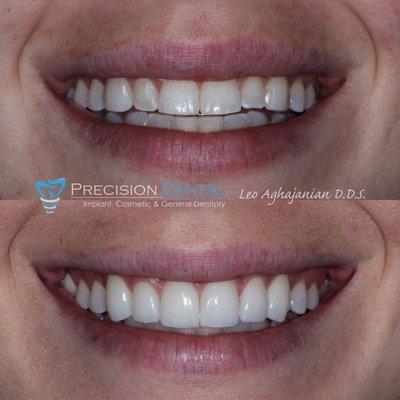 Dr. Leo was able to achieve an amazing smile makeover using ceramic crowns. Our patient was ecstatic with her results.