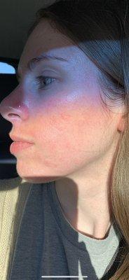 In car immediately post hydrafacial with Victoria - super smooth and very little redness!