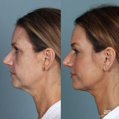 Deep plane face and neck lift, brow lift, with fat grafting to mid face. One year post-op!