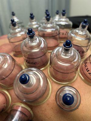 Do you have chronic pain? Cupping therapy may give you relief! Schedule an appointment today!