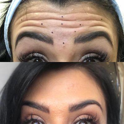 Botox before/after