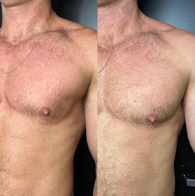 Chest Augmentation with Bio-Filler