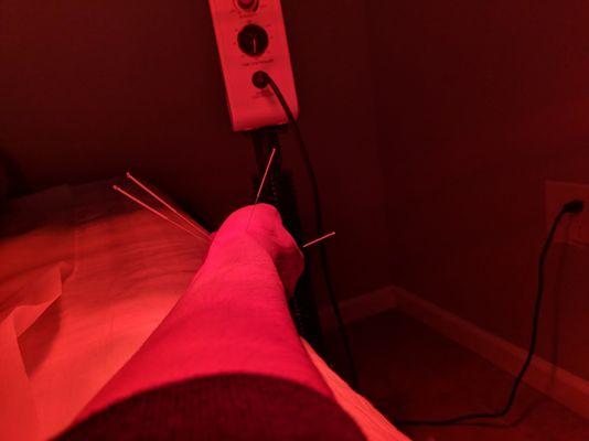 Acupuncture + heat lamp