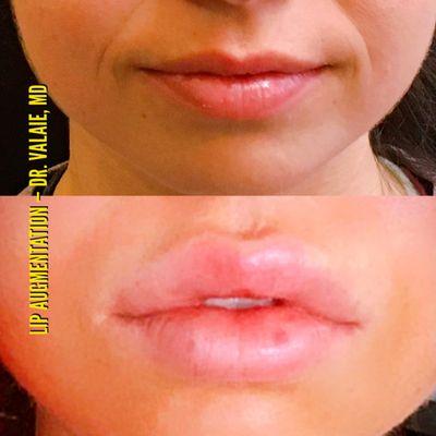 Lip Augmentation - Dr.Valaie, MD