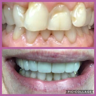 Smile design by Dr. Sherri Bluth