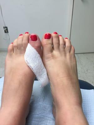 Sugar Scrub technician caused a very painful ingrown toenail which resulted in infection and minor surgery.