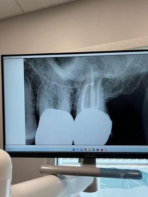 After the procedure you can see how well they got into the little root canals. The big white in the lower edge of the photo are my crowns.