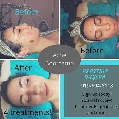 Acne Bootcamp