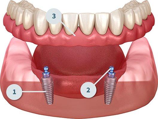 Implant Dentist 
Implant Dentures on site