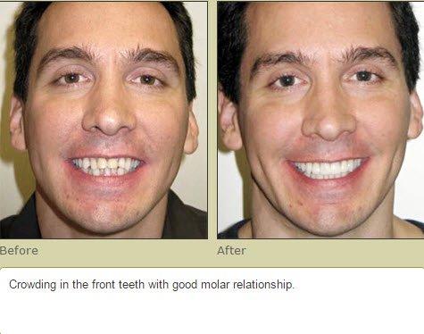 Invisalign Results