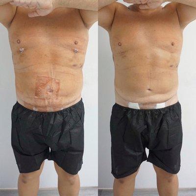 1 session of a post operative treatment. client was surgeon referred, lipo 360 male sculpting.