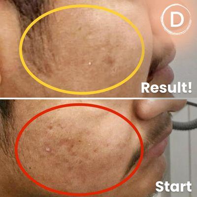 Acne treatment (medical)