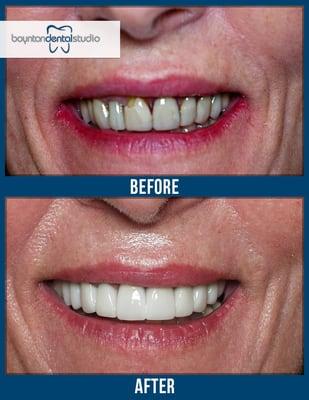 Boynton Dental Studio Patient Before and After Cosmetic Veneers