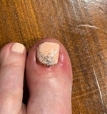 I had to put medicine on my toe for several days, so it wouldn't get infected.