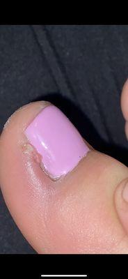 Raw skin after pedicure.