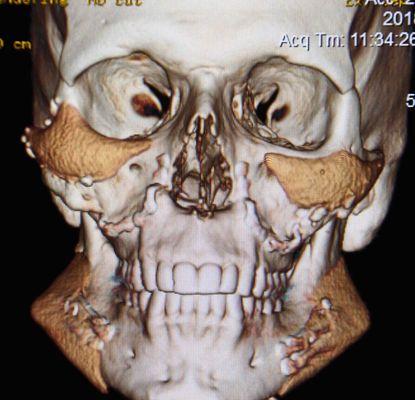 Left cheek implant lower than right and missing a substantial piece at top which Eppley cut off rather than reposition poorly placed implant