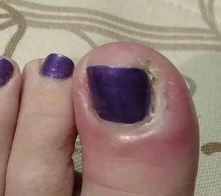 Infected toe from her stabbing me with her trimming tool. Don't go here!