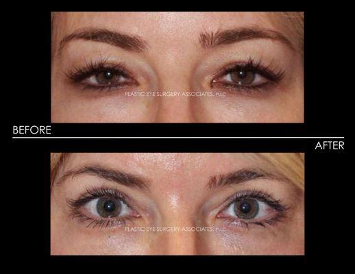 UPPER BLEPHAROPLASTY WITH PTOSIS REPAIR