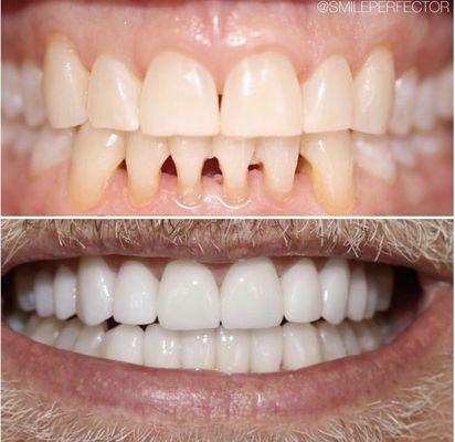 Full mouth smile makeover.
Combination of 20 porcelain crowns & veneers 
(10 upper & 10 lower custom restorations)