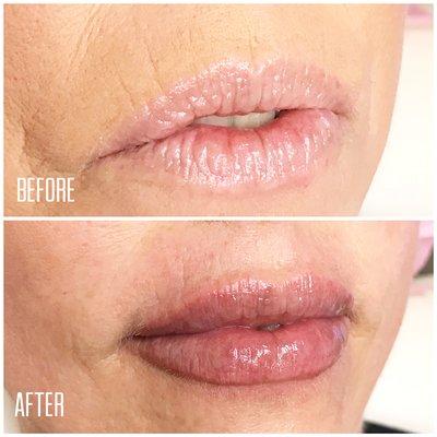 That perfect pout with filler! Lasts 1-2 years