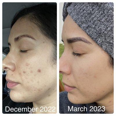 Results are from monthly 60 min custom facials and a good skincare routine