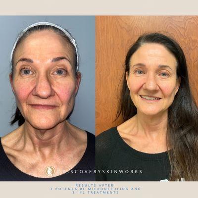 Results after 3 Potenza RF Microneedling and 3 IPL treatments. We targeted fine lines and wrinkles, discoloration, and more!