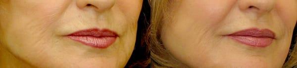 Before and after juvederm by Reva