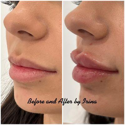 Lips augmented with HA filler