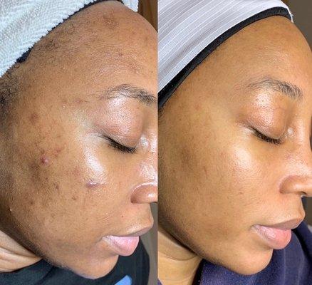 Acne program + proper skin care regimen