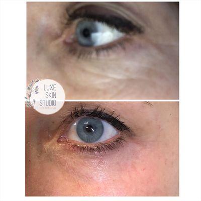 Plasma Lift - Under eye skin tightening