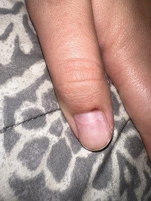 Cut thumb