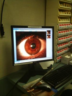 Slit lamp imaging often can reveal the underlying causes of dry, red, irritated eyes.