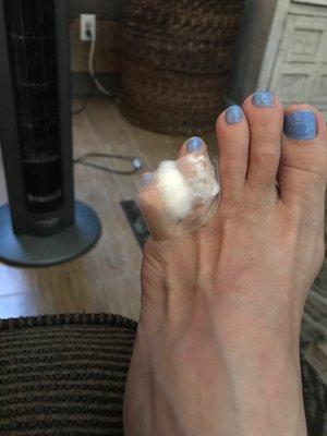 Left small toe is broken. Rather than tape all toes together they put cotton balls & taped at an angle (incorrectly).