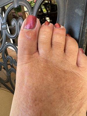 My infected foot after my pedicure from the brothers nail salon.