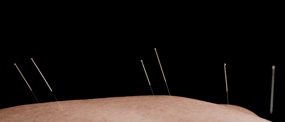 We Offer Acupuncture - There are so many benefits which include but are not limited to Stress Relief, Pain Relief, Depression and more!