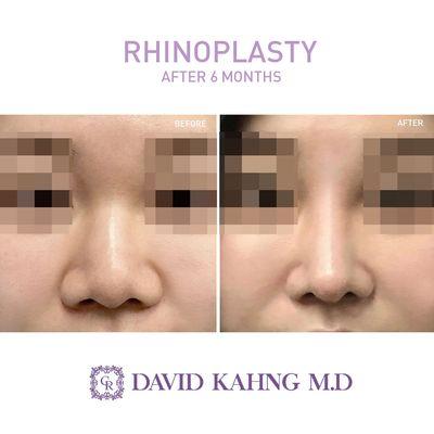 Rhinoplasty before & after photo by CARA Plastic Surgery & Laser Center