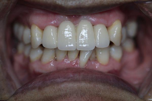 After cosmetic anterior crowns restoration