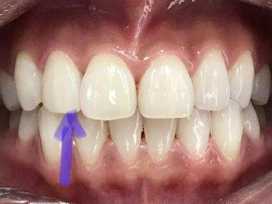 Single crown matched to the adjacent teeth