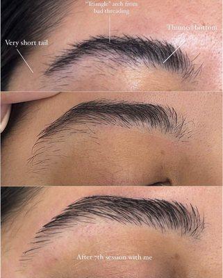 Brow Rehab Reconstruction Before & After