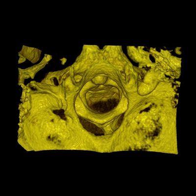 3D CBCT image showing the top-down view of someone's spine.