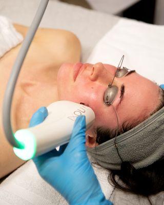 Moxi Resurfacing Laser Treatment at Faces in Bloom in Vancouver Wa