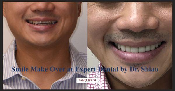 Smile Make Over by Dr. Shiao