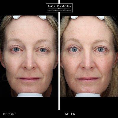 Upper eyelid lift by Jack Zamora MD