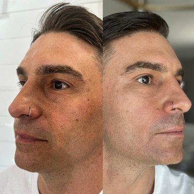 Full face fibroblast before and after