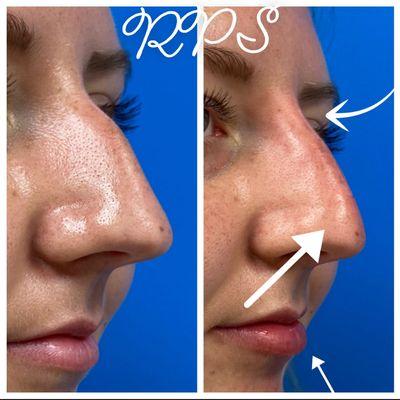 No surgical rhinoplasty