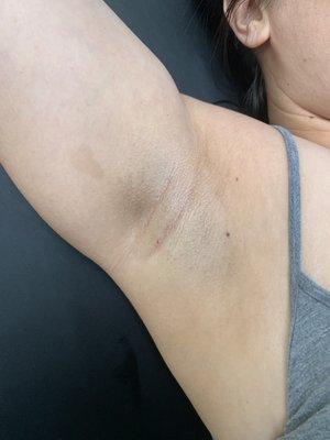 Immediately after underarm wax service