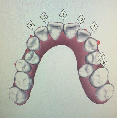 Invisalign pre-treatment.