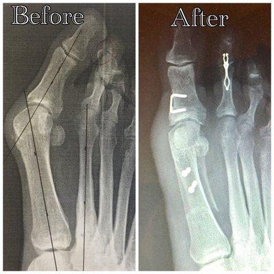 Bunion and second hammertoe correction.