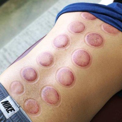 Cupping therapy