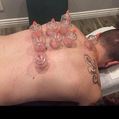 Cupping